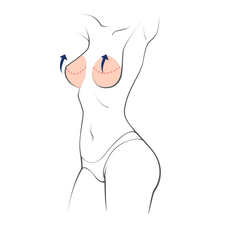 Breast Uplift (Mastopexy)