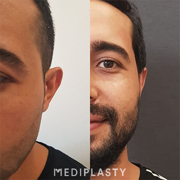 Ear Aesthetics (Otoplasty)