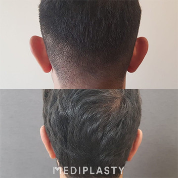 Ear Aesthetics (Otoplasty)