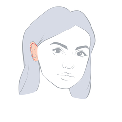 Ear Aesthetics (Otoplasty)