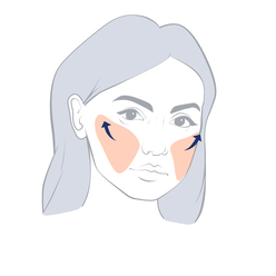 Endoscopic Mid-face Lift